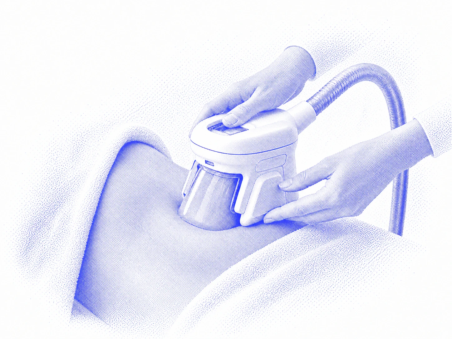 Interprétation graphique bleue d’un applicateur de cryolipolyse positionné sur l’abdomen