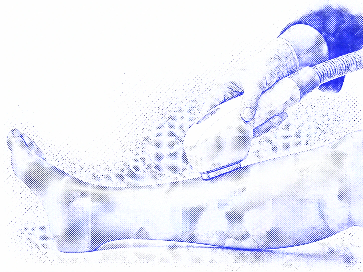 Interprétation graphique bleue d’un soin d’épilation laser sur la jambe